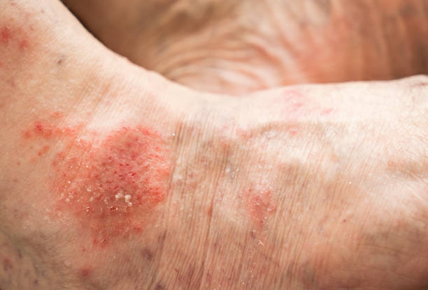 Dommages causés par des insectes xylophage